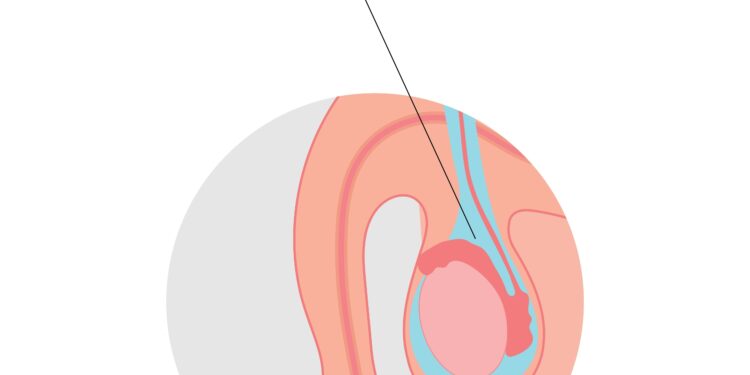 Hidrocelė: priežastys, simptomai, diagnostika ir gydymas