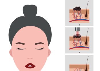 Hemangiomų tipai, priežastys ir gydymas