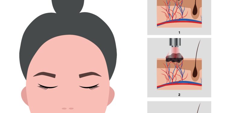 Hemangiomų tipai, priežastys ir gydymas