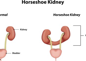 Pasagos formos inkstas (inkstų susiliejimas): priežastys ir gydymas