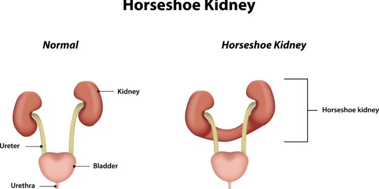 Pasagos formos inkstas (inkstų susiliejimas): priežastys ir gydymas