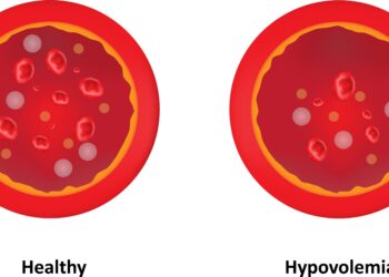 Hipovolemija: simptomai, priežastys ir gydymas