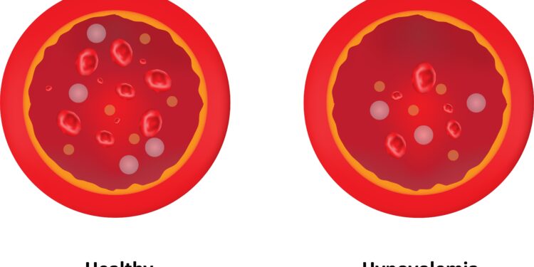 Hipovolemija: simptomai, priežastys ir gydymas
