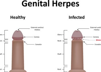 Varpos sąaugos (varpos odos tiltai): priežastys ir gydymas