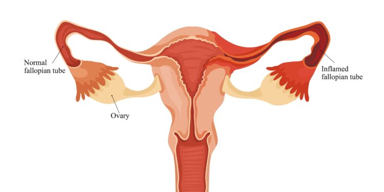 Parovarinė cista: dydžiai, simptomai, diagnostika ir gydymas