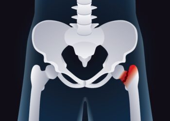 Sąnarių kraujavimas (hemartrozė): priežastys, simptomai ir gydymas