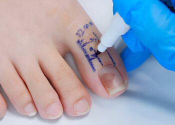 Storasis kojos pirštas