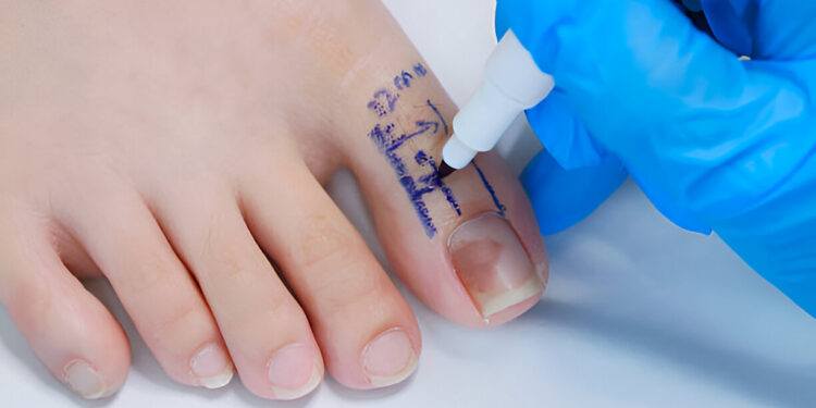 Storasis kojos pirštas