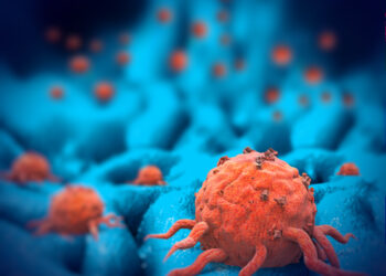 Kasos neuroendokrininiai navikai: simptomai ir gydymas