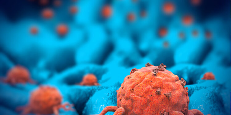 Kasos neuroendokrininiai navikai: simptomai ir gydymas