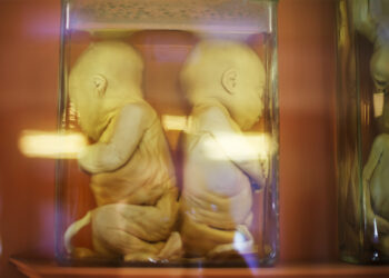 Parazitiniai dvyniai: priežastys, diagnostika ir šalinimas