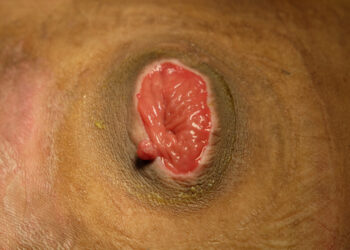 Lipschützo opa: priežastys, simptomai ir gydymas