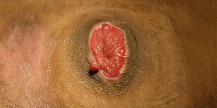 Lipschützo opa: priežastys, simptomai ir gydymas