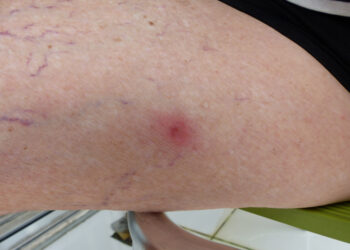 Ugninių skruzdėlių įkandimai: kaip atrodo, gydymas ir naminės priemonės