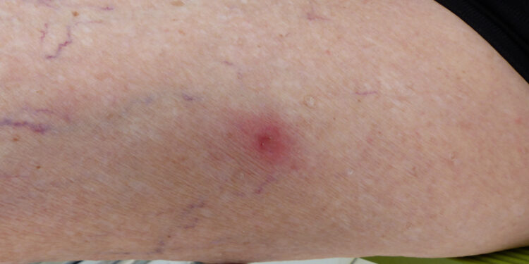 Ugninių skruzdėlių įkandimai: kaip atrodo, gydymas ir naminės priemonės