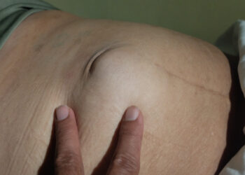 Įstrigusi išvarža