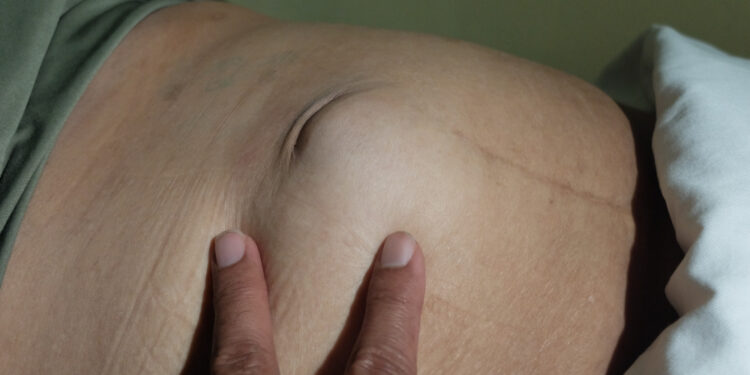 Įstrigusi išvarža: kas tai, simptomai ir gydymas