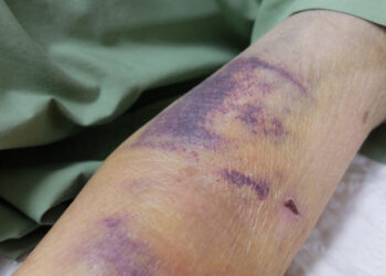 VII krešėjimo faktoriaus stoka: simptomai, priežastys ir gydymas