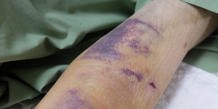 VII krešėjimo faktoriaus stoka: simptomai, priežastys ir gydymas