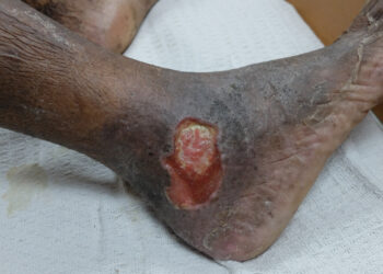 Kojų opos: priežastys, tipai, gydymas ir svarbiausia informacija