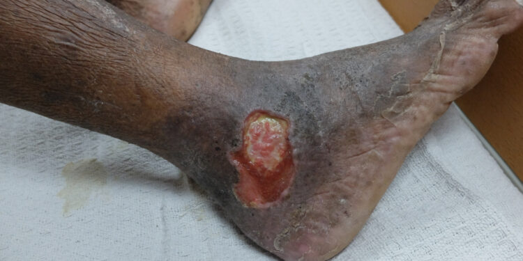 Kojų opos: priežastys, tipai, gydymas ir svarbiausia informacija