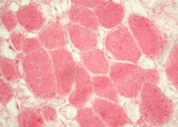 McArdle liga (GSD5): kas tai, simptomai ir gydymas
