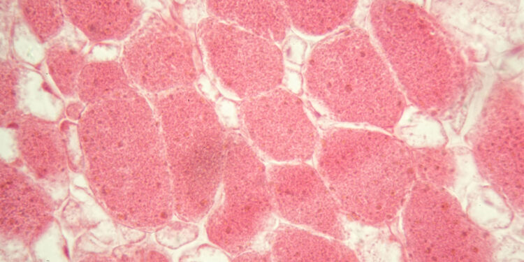 McArdle liga (GSD5): kas tai, simptomai ir gydymas