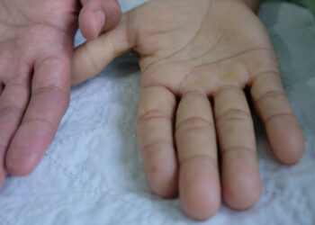 Megaloblastinė mažakraujystė: kas tai, simptomai, priežastys ir gydymas