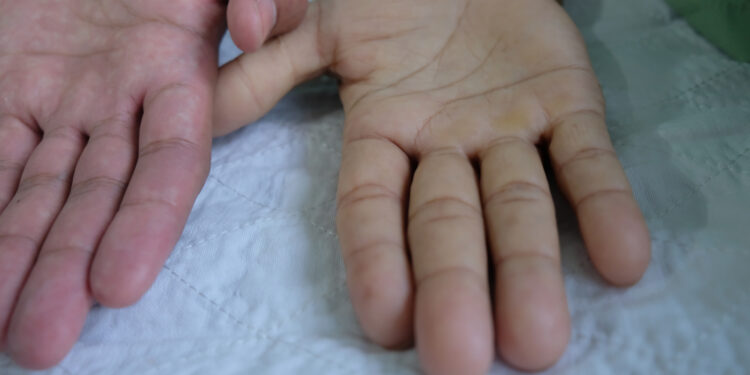 Megaloblastinė mažakraujystė: kas tai, simptomai, priežastys ir gydymas