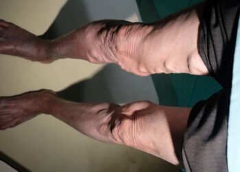 Didžioji poodinė vena