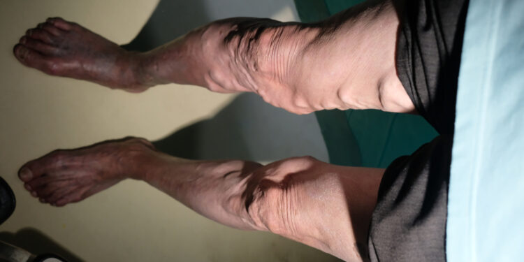 Didžioji poodinė vena