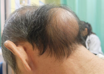 Plauko maišelio cista: priežastys, šalinimas ir esmė