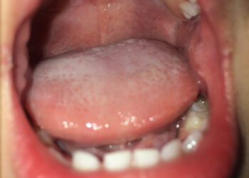 Dantenų ir burnos gleivinės uždegimas: tipai, simptomai ir gydymas
