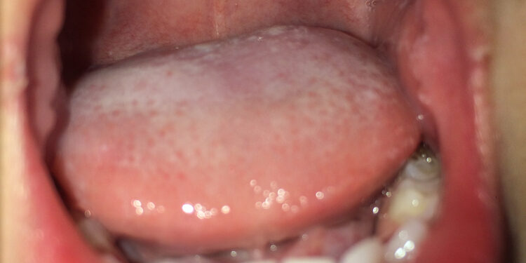 Dantenų ir burnos gleivinės uždegimas: tipai, simptomai ir gydymas