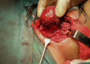 Prieskydinės liaukos adenoma