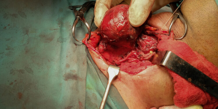 Prieskydinės liaukos adenoma