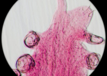 Kabligės infekcija: simptomai, gydymas ir užsikrėtimo būdai