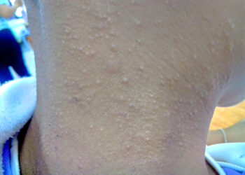 Lichen spinulosus: simptomai, priežastys ir gydymas