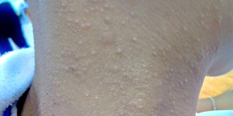 Lichen spinulosus: simptomai, priežastys ir gydymas