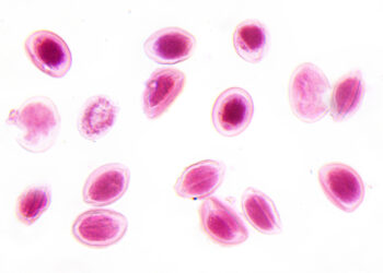 Pelgerio–Hueto anomalija: simptomai, priežastys ir gydymas