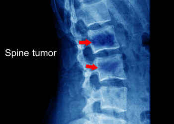 Osteochondroma: kas tai, simptomai ir gydymas