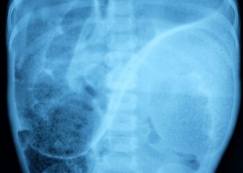 Hiršprungo liga: kas tai, simptomai ir gydymas