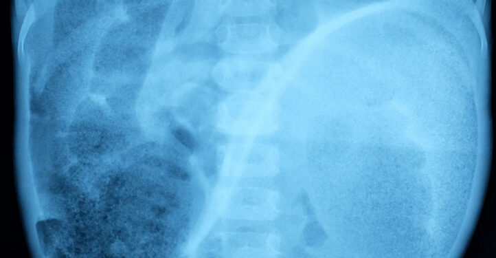 Hiršprungo liga: kas tai, simptomai ir gydymas