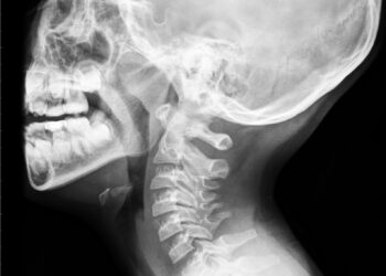 Klippelio–Feilio sindromas (KFS): kas tai, simptomai, priežastys ir gydymas