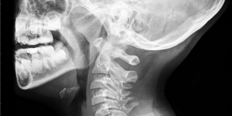 Klippelio–Feilio sindromas (KFS): kas tai, simptomai, priežastys ir gydymas