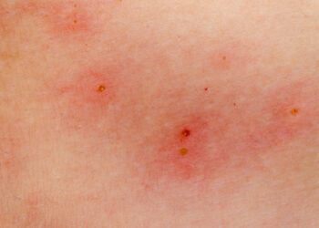 Popierinių vapsvų įgėlimas: reakcija ir gydymas