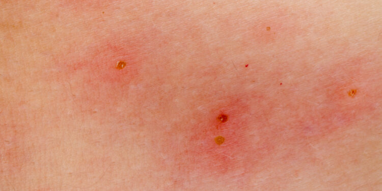 Popierinių vapsvų įgėlimas: reakcija ir gydymas