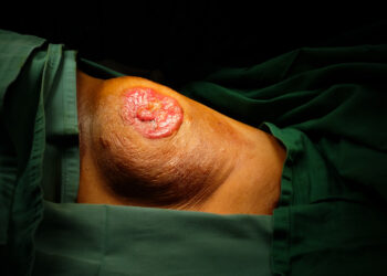 Ekstramamarioji Pageto liga: simptomai, priežastys ir gydymas