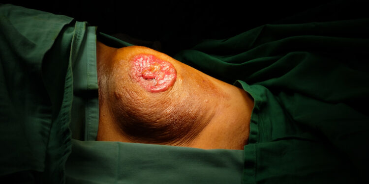 Ekstramamarioji Pageto liga: simptomai, priežastys ir gydymas