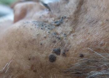 Plaukuotojų ląstelių leukemija: simptomai, priežastys ir gydymas